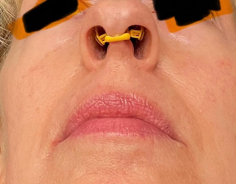 Rhinomed Turbine Sport Nasal Dilators, 38% More Air | Performance Breathing Aid for Exercise & Fitness, Reusable, Drug-Free, Nose Strip Alternative, Comfortable & Adjustable Fit customer photo 2