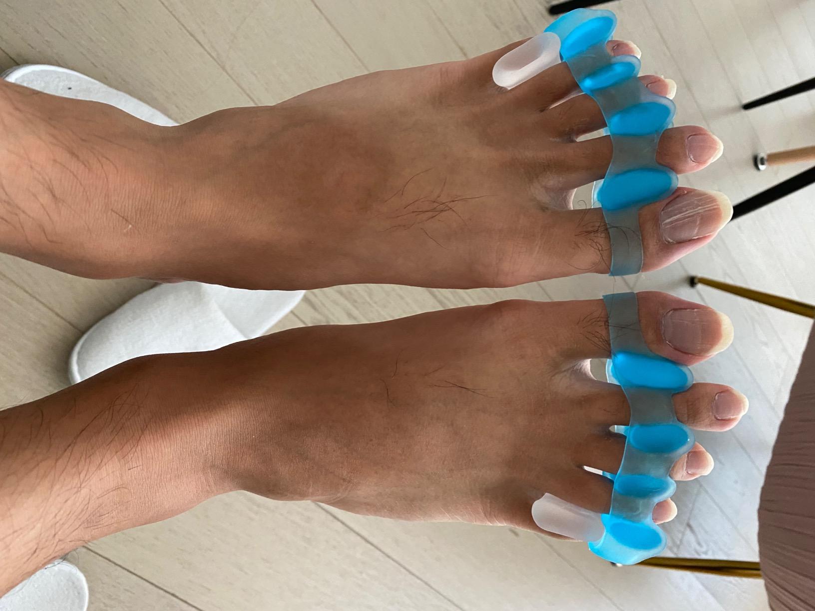 NatraCure Gel Toe Spacers 12 Pack - Helps with Bunions, Corns, Blisters, Rubbing & Overlapping Toes - Toe Separators for Women & Men to Correct Toes customer photo 1