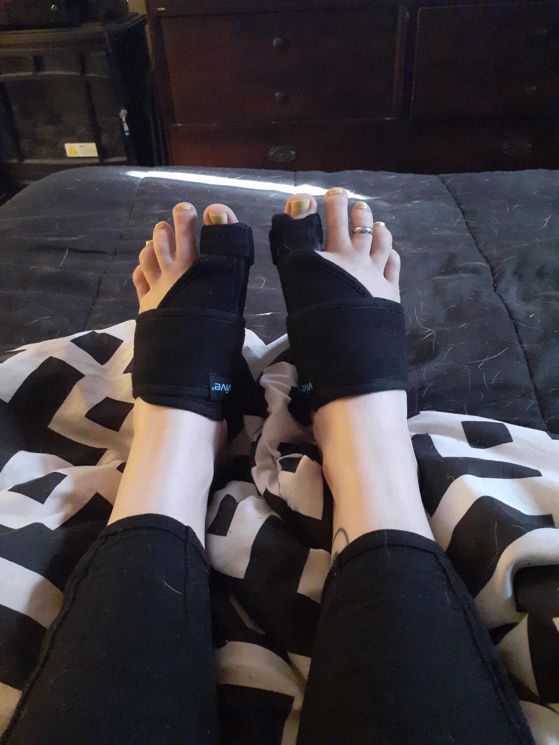 Vive Bunion Brace (Pair) - Big Toe Corrector Straightener with Splint | Hallux Valgus Pad, Joint Pain Relief, Alignment Treatment - Orthopedic Sleeve Foot Wrap Support for Men and Women (Black) customer photo 2
