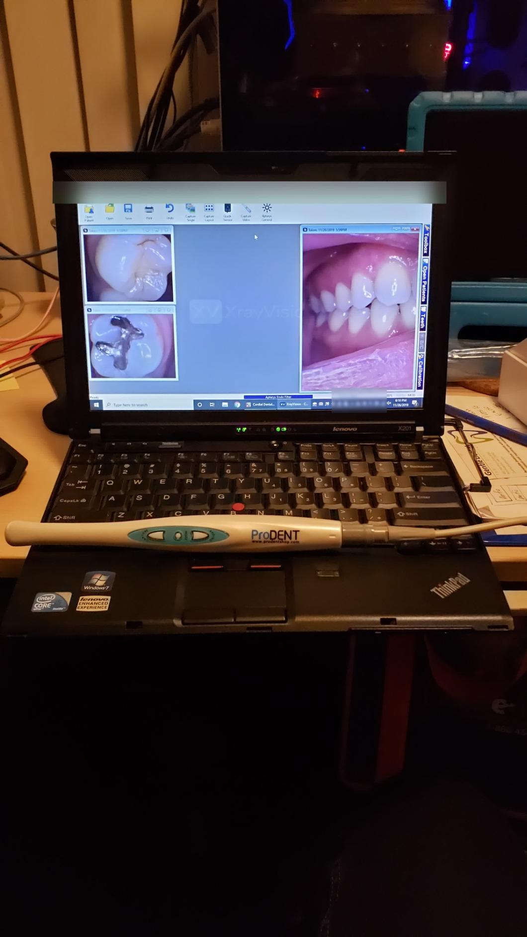 ProDENT HD Intraoral Camera PD760, USB Dental Camera, Capture Button Work with Eaglesoft, Dexis, Carestream, opendental, Apteryx, curvehero and More customer photo 1