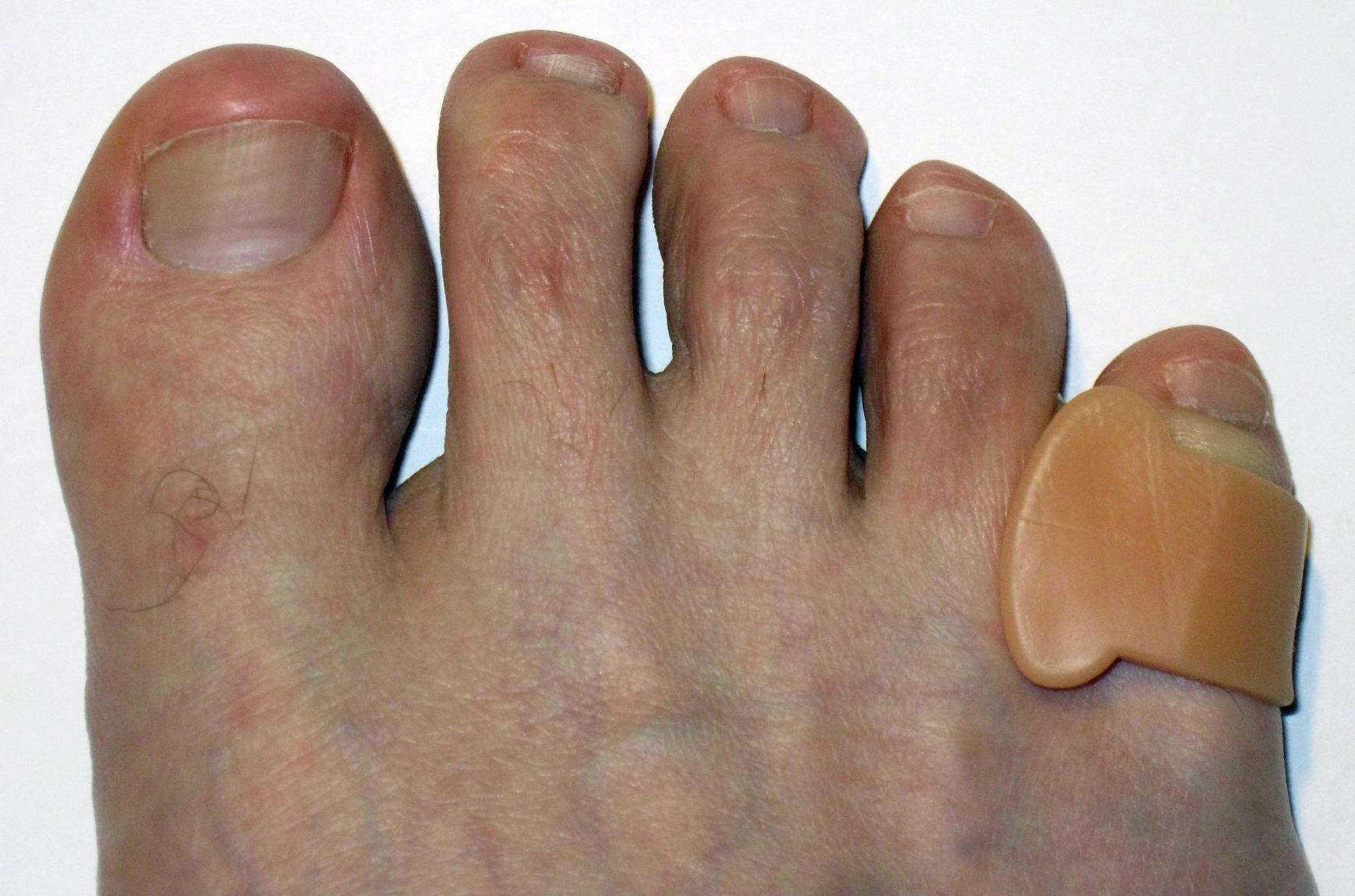 ZenToes Gel Toe Spacers for Bunions & Overlapping Toes, 4 Count | Gel toe separators for women & men. Big toe alignment, crooked toes. Fits sneakers, sandals & heels. Washable customer photo 2