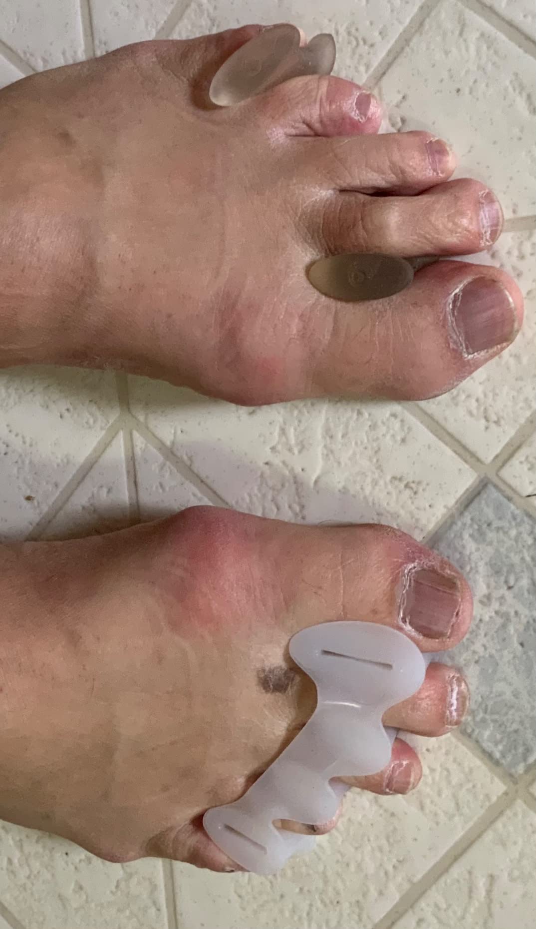 Toe Separators for Foot Alignment- Strengthening and Balance- For Hammertoes, Bunions, Plantar Fasciitis, Hallux Valgus - Spreaders- Size Large (1 pair) customer photo 2
