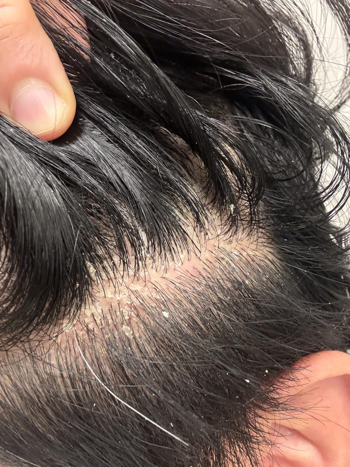 Selsun Blue Medicated Antidandruff Shampoo, 11 fl. oz. customer photo 2