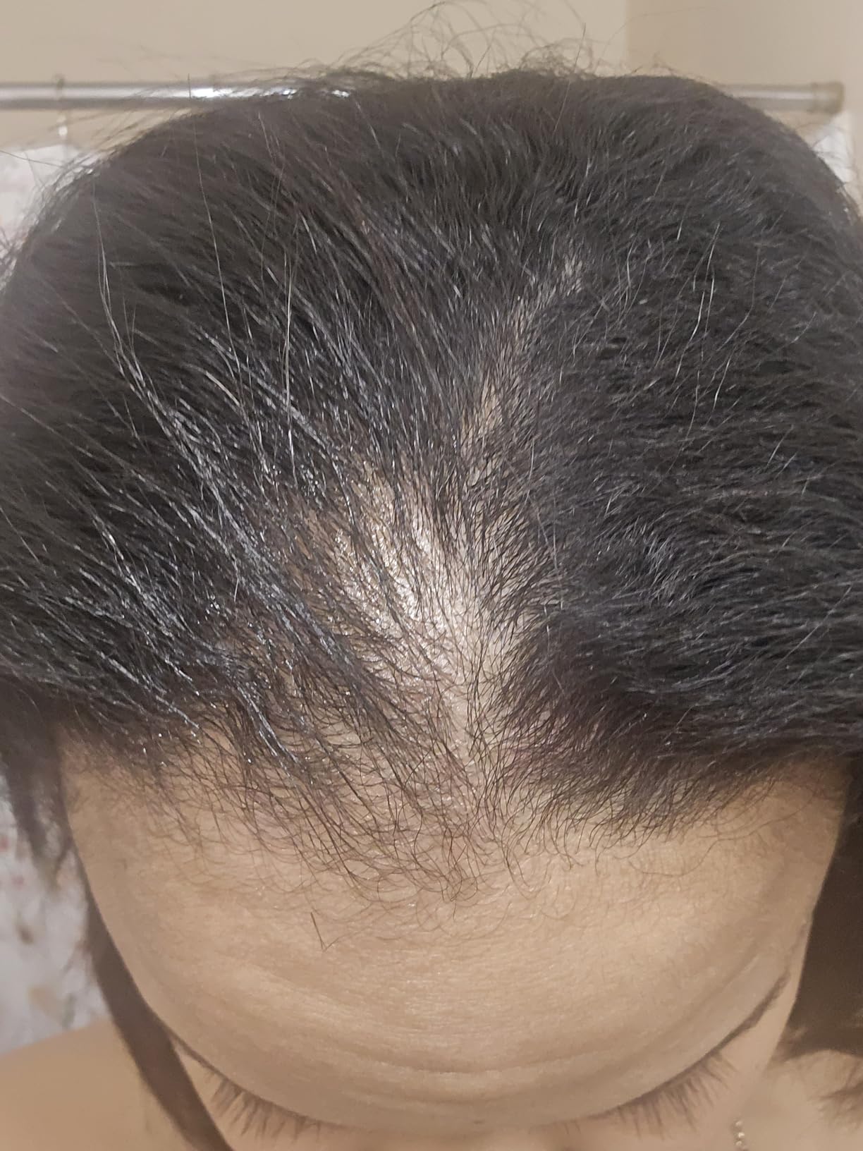 Nizoral Psoriasis Shampoo & Conditioner, 11 Oz, Gentle Scalp Treatment customer photo 2