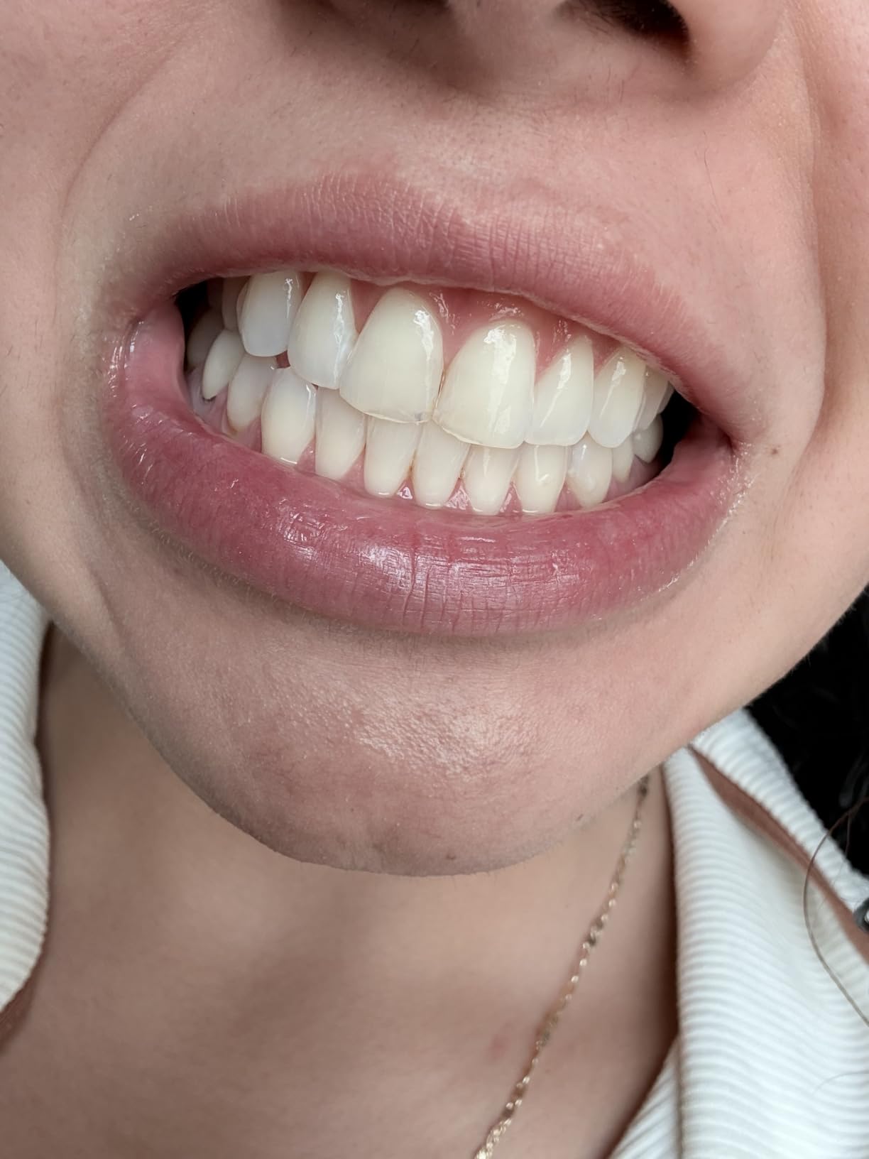 Crest 3DWhitestrips Sensitive White At-Home Teeth Whitening Kit, 18 Treatments, Gently Removes 15 Years of Stains customer photo 1